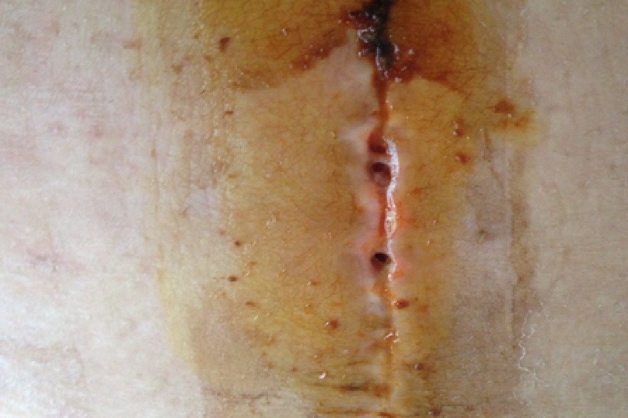 剖腹产术后线头不吸收图