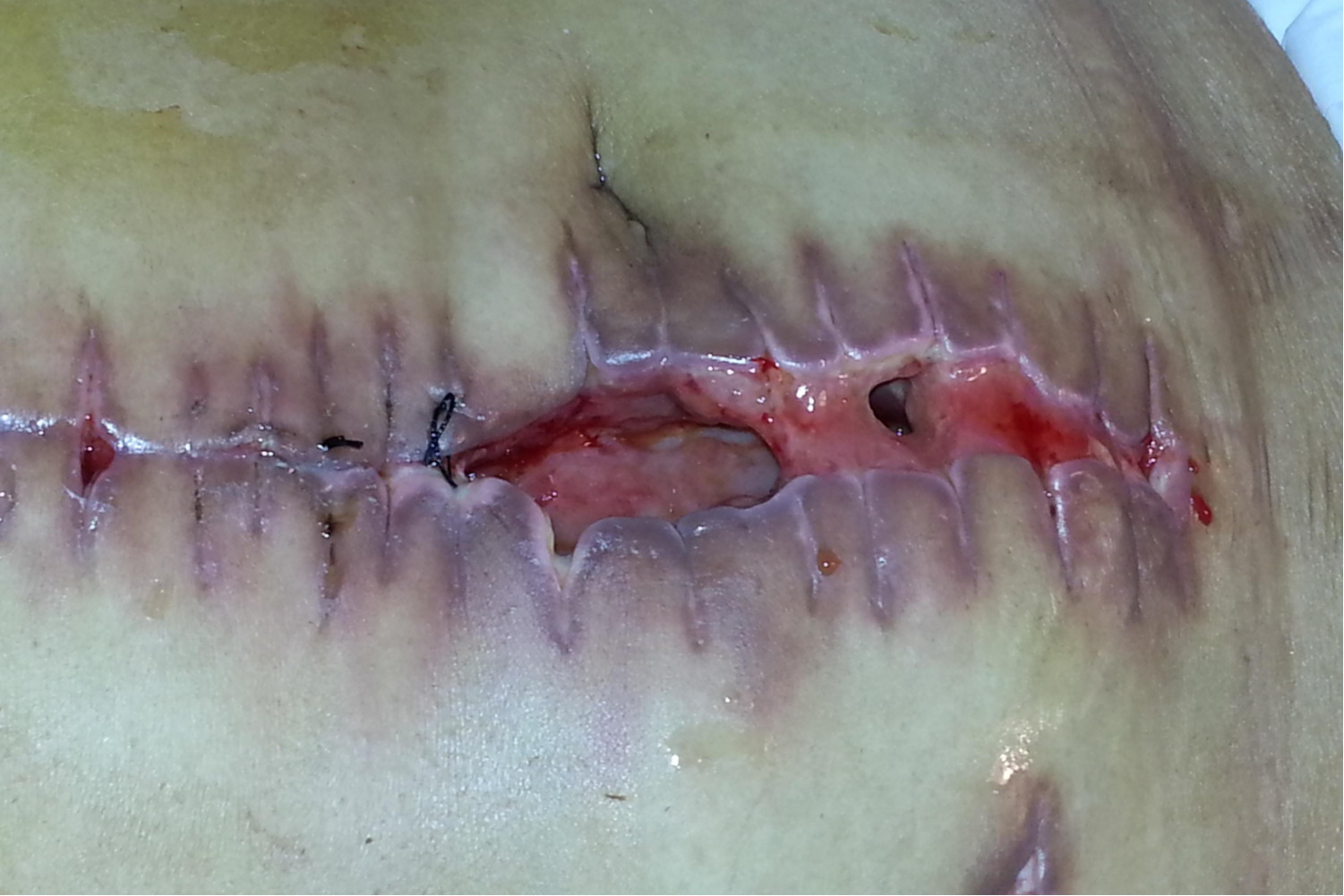 剖腹产脂肪液化