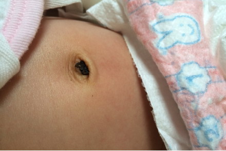 脐带掉了还有黑色结痂图片