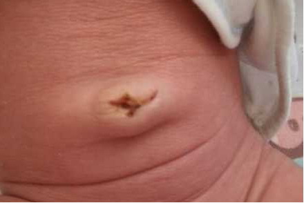 脐带脱落后不正常图