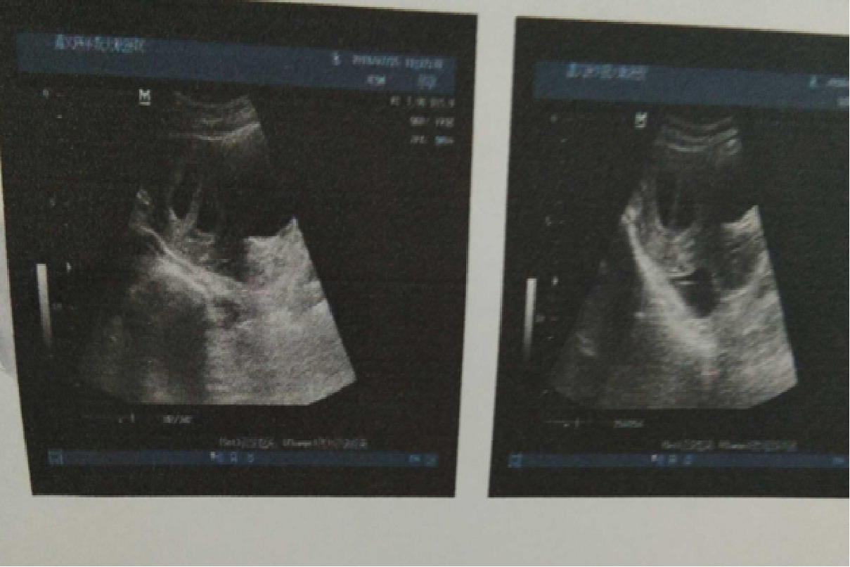 同卵双胞胎b超图