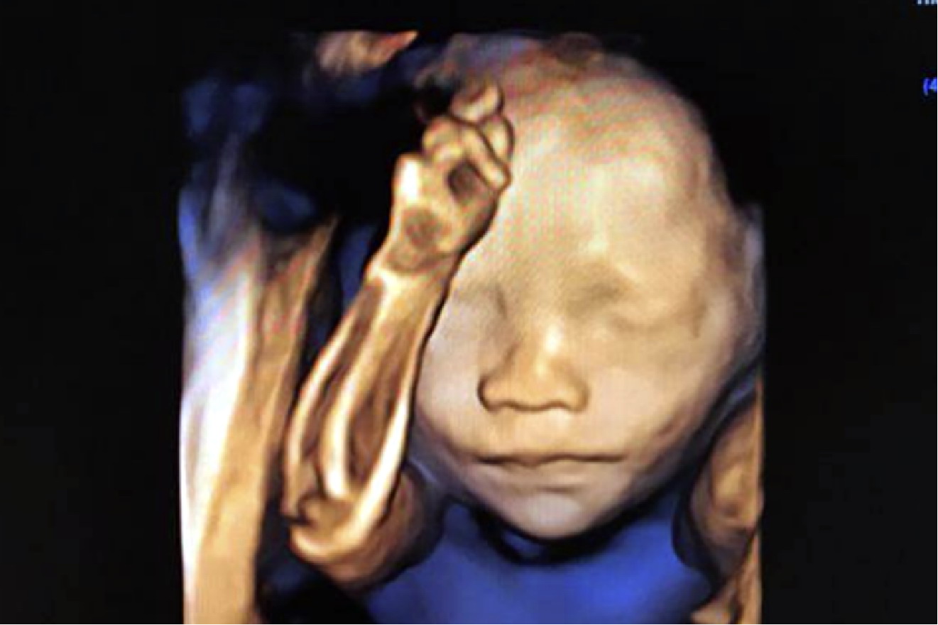 四维彩超塌鼻梁图