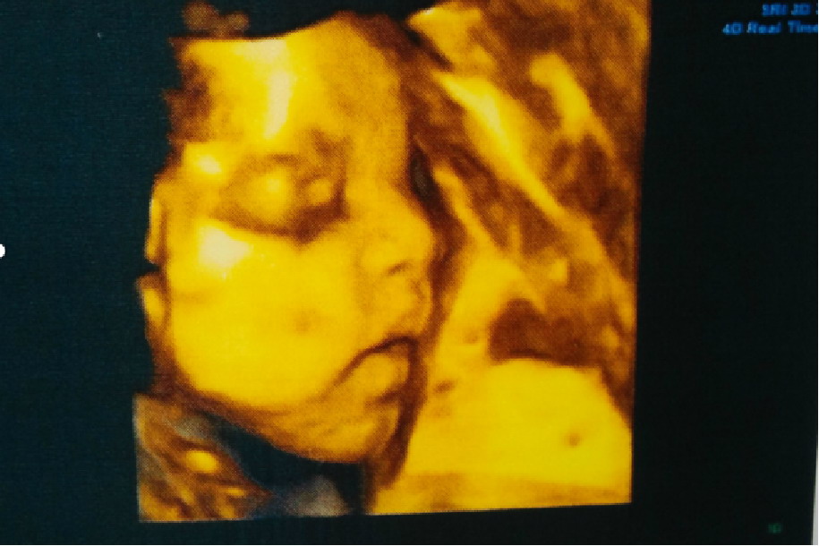 四维彩超高鼻梁图