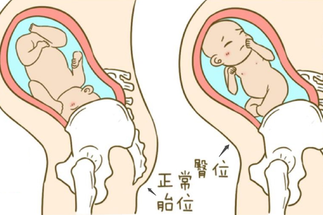 胎儿在子宫的正常胎位及臀位图