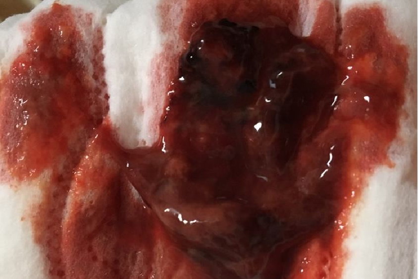 引产后正常恶露