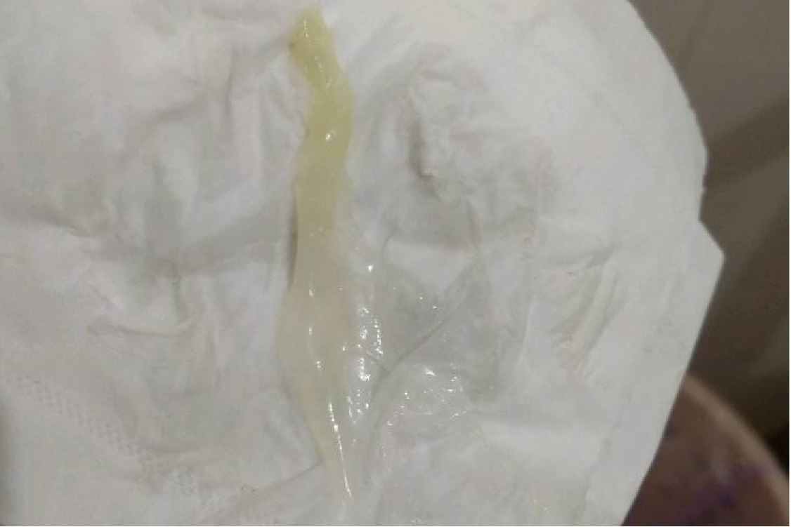 孕晚期正常分泌物