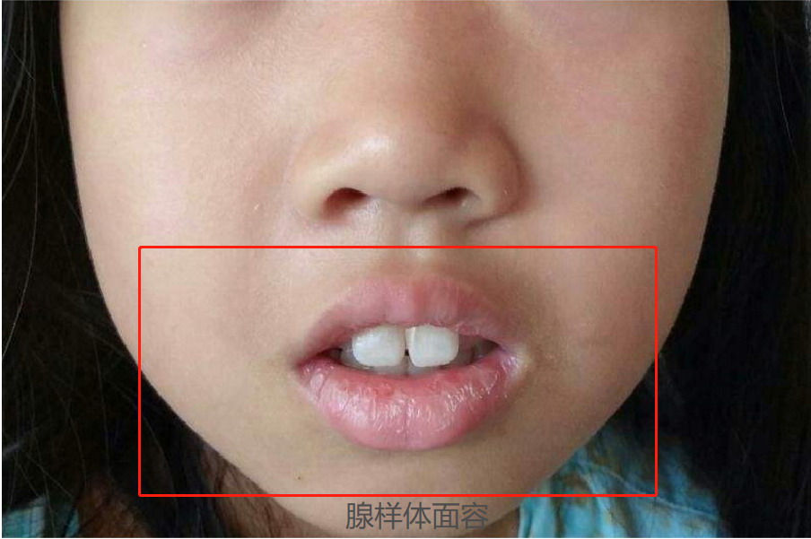 腺样体肥大患者面容图片
