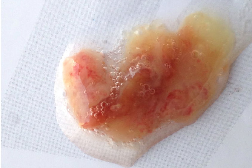 正常咽炎咳出血图