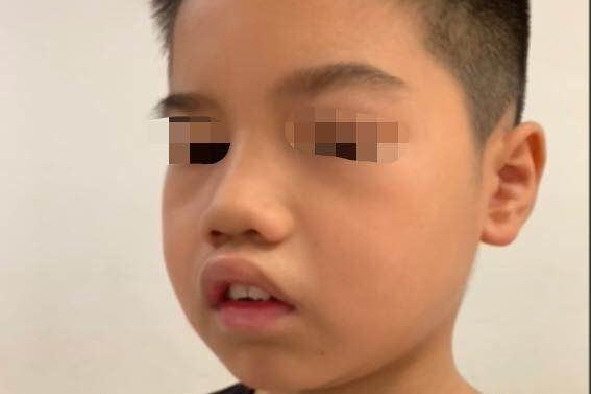 腺样体肥大面容图