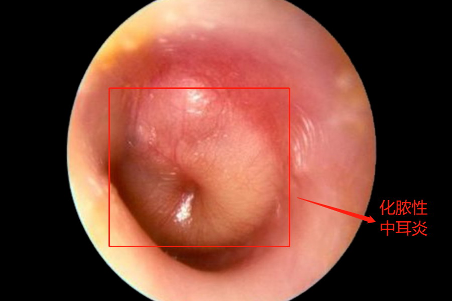 化脓性中耳炎图