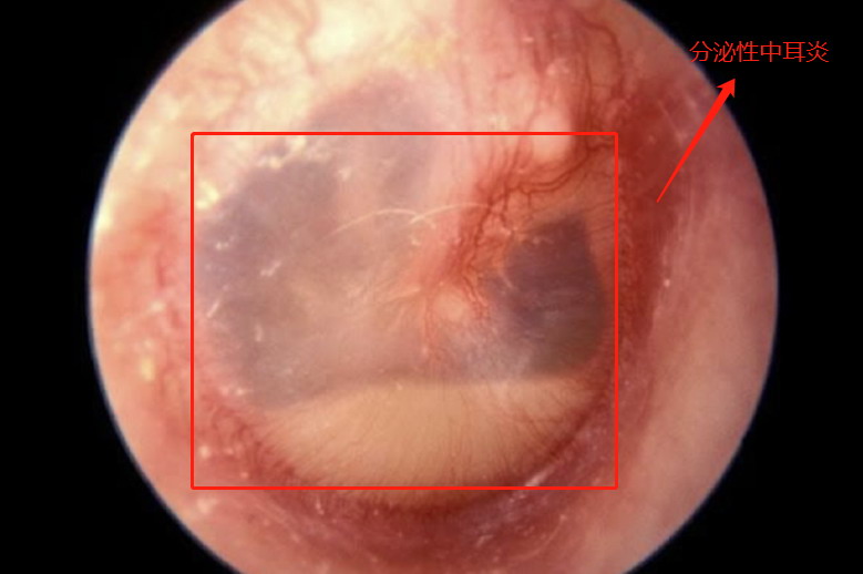 分泌性中耳炎图