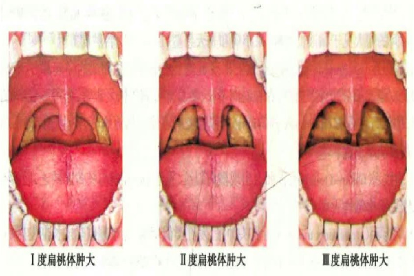 扁桃体肿大一度二度三度图