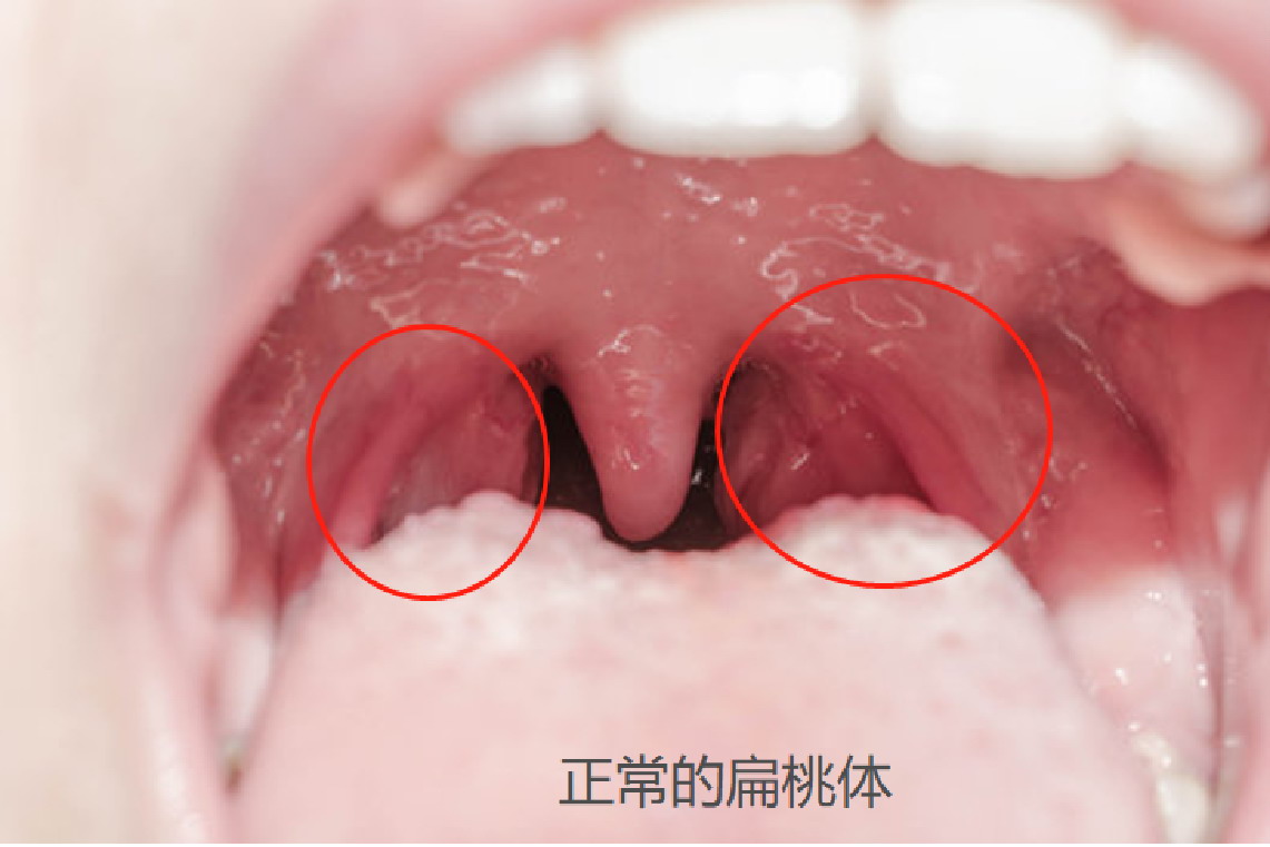 扁桃体正常的图