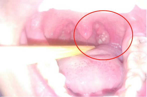 喉咙白色米粒图