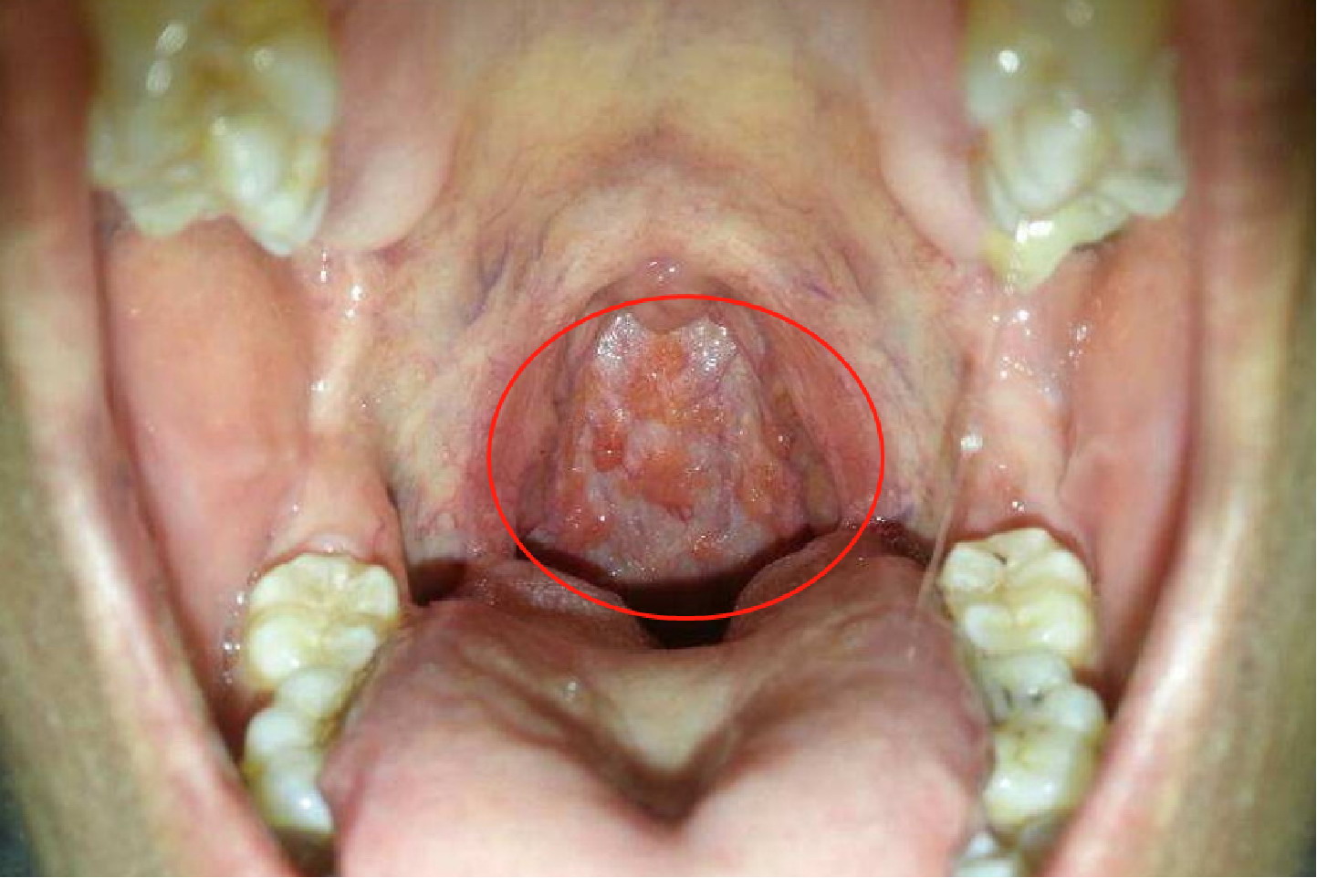 喉咙内壁长疙瘩图