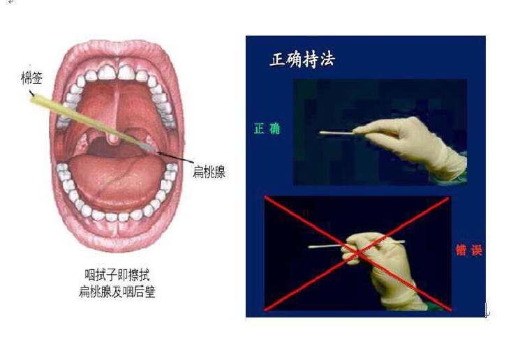 采集咽拭子准确部位图