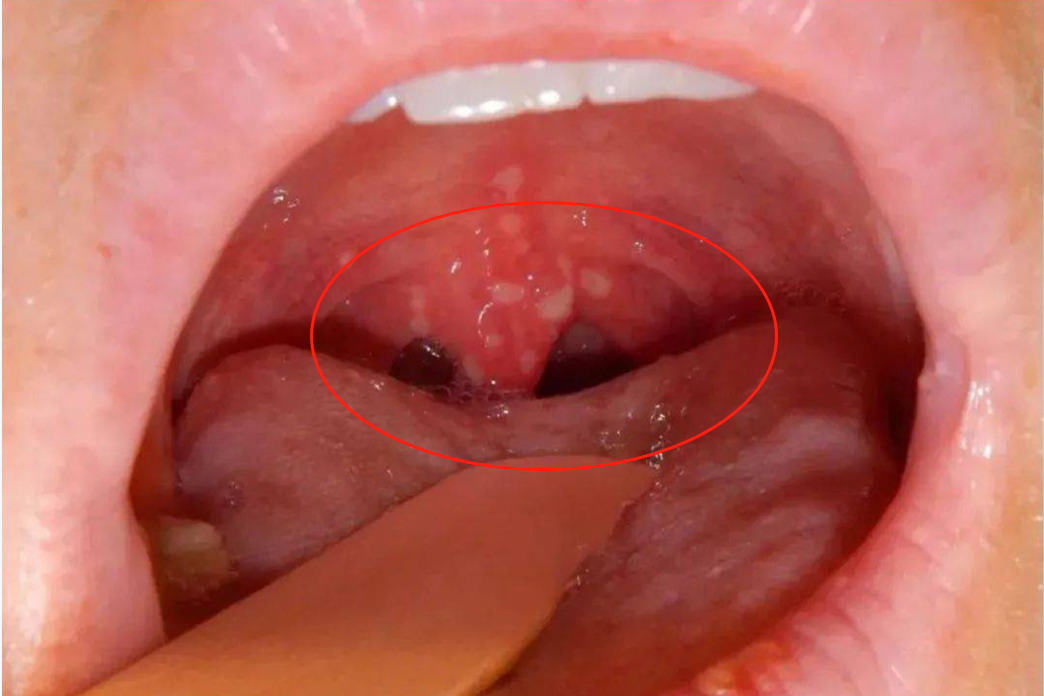 咽喉壁有水泡图片
