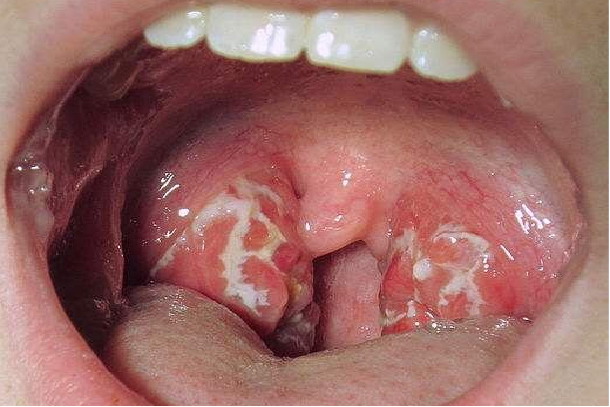 扁桃体化脓最严重图