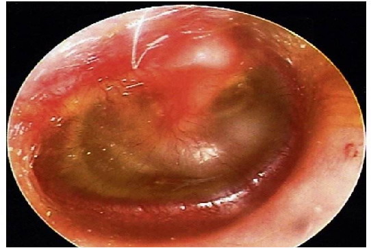3个月宝宝中耳炎初期图