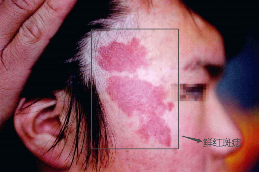 鲜红斑痣图片
