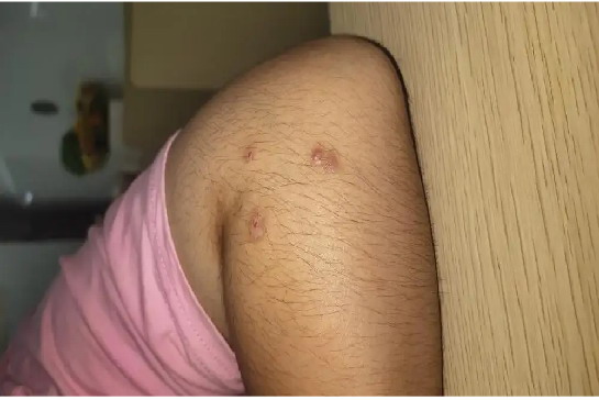 蟑螂咬人后的皮肤症状图片