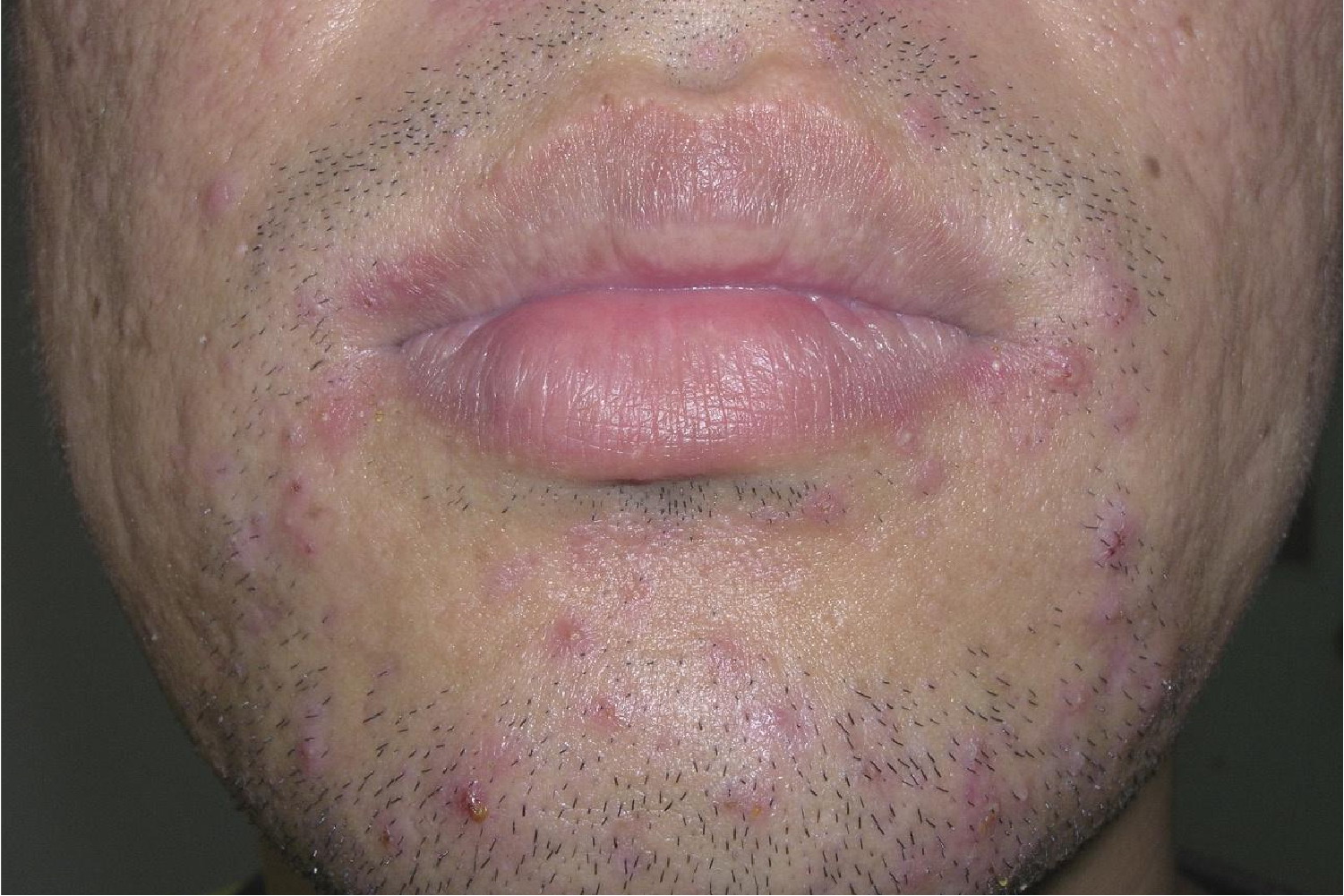 羊胡子疮症状图