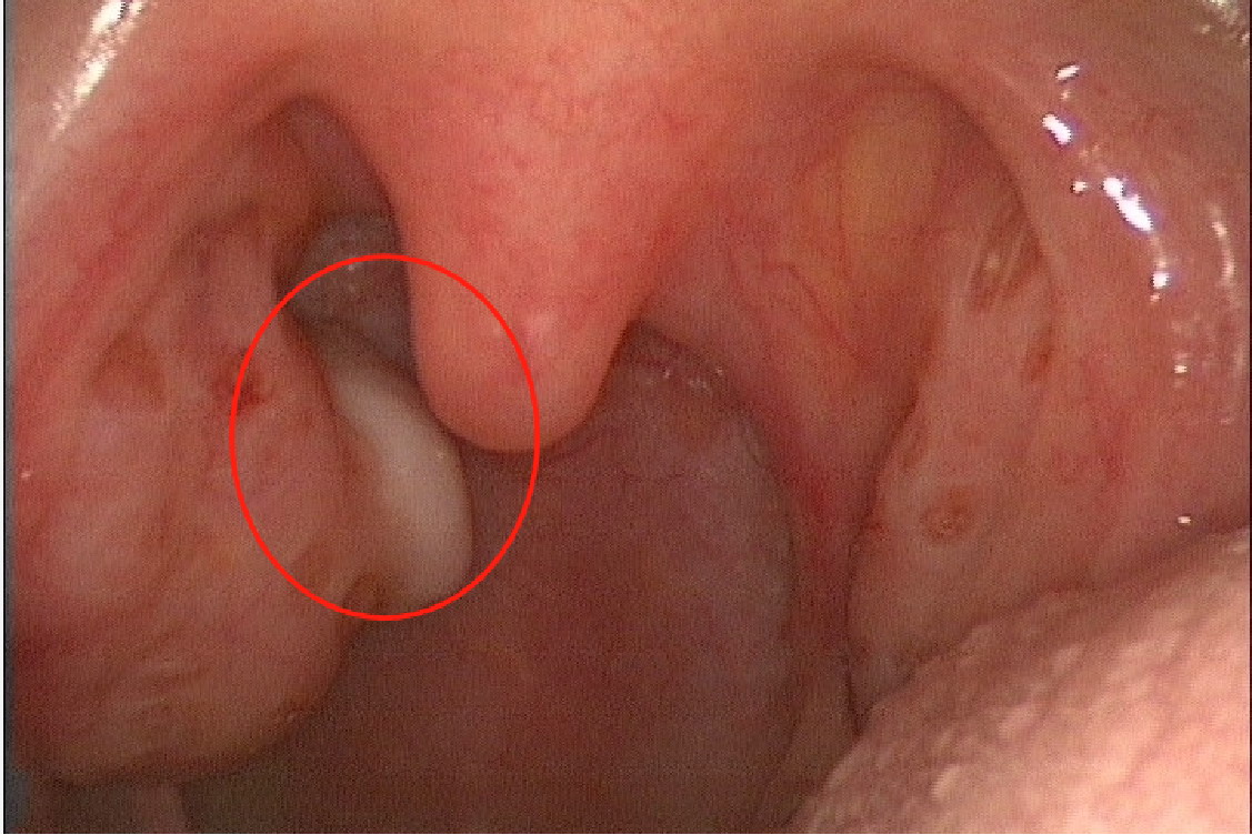 扁桃体旁边长息肉图