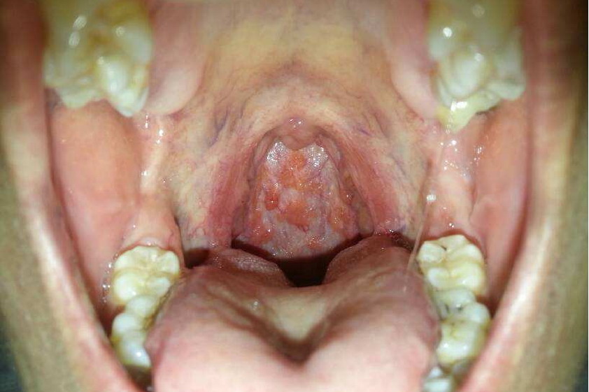 正常咽喉舌根疙瘩图片