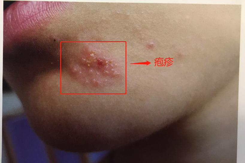 下巴疱疹最初症状图