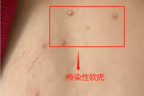 传染性软疣图