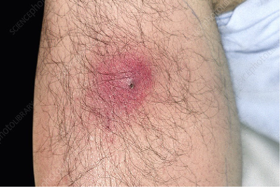 毛囊炎形成大硬结图片