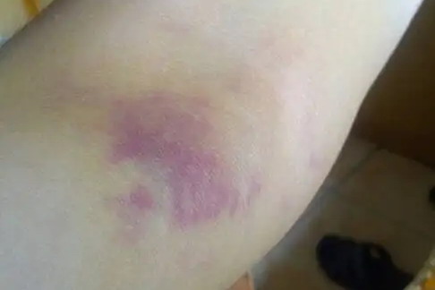 皮下出血图片
