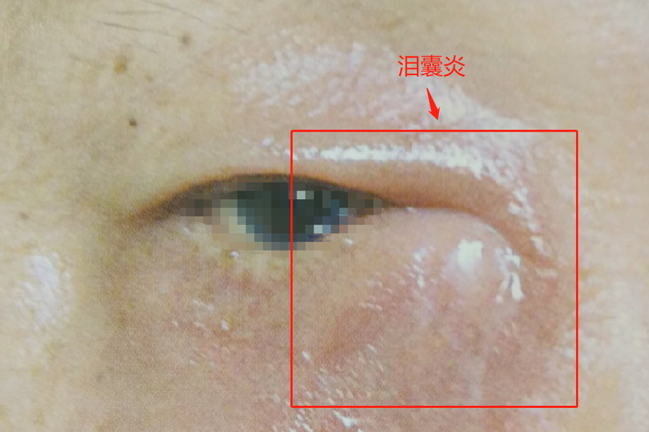泪囊炎图