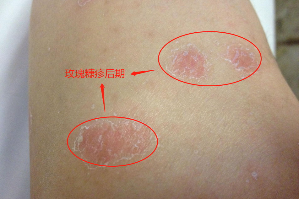 玫瑰糠疹后期蜕皮图