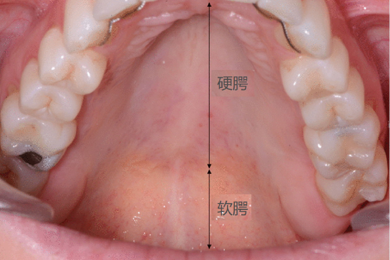 软腭位置图