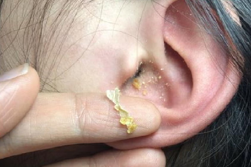 引起耳道耵聍蓄积,栓塞的常见原因包括耳道皮肤过度脱落,皮脂腺,耵聍