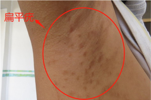 长在腋窝的扁平疣图