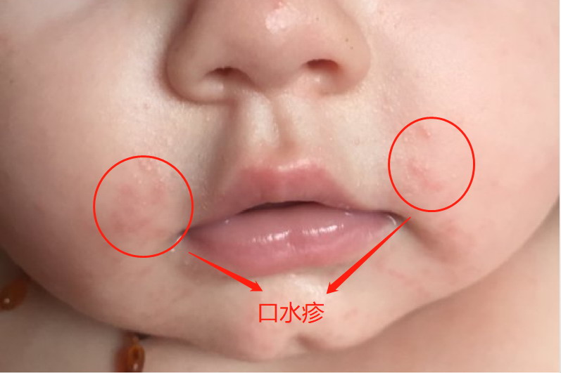 口水疹图片