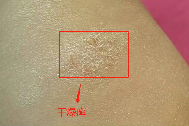 干燥癣图