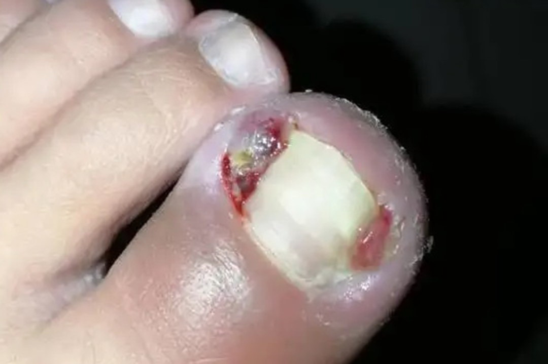 甲沟炎息肉较严重图