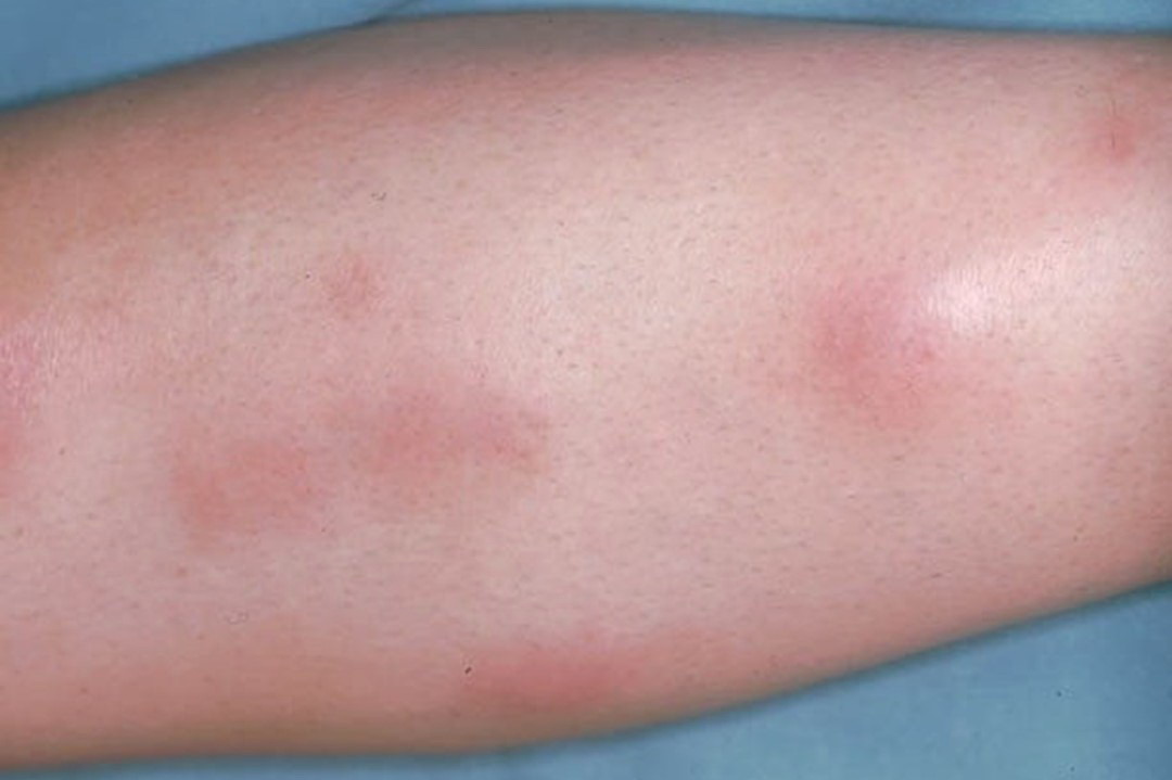 早期结节性红斑