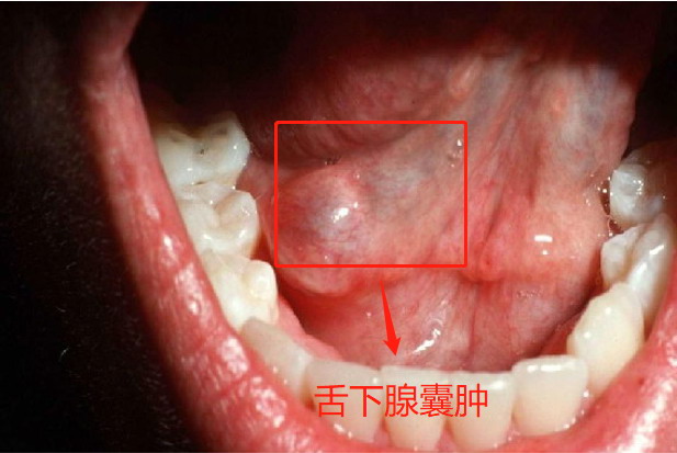 舌下腺囊肿图