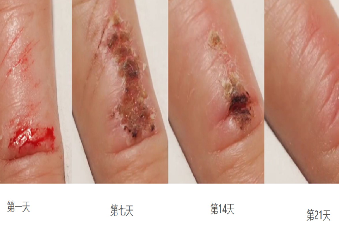 正常伤口愈合过程