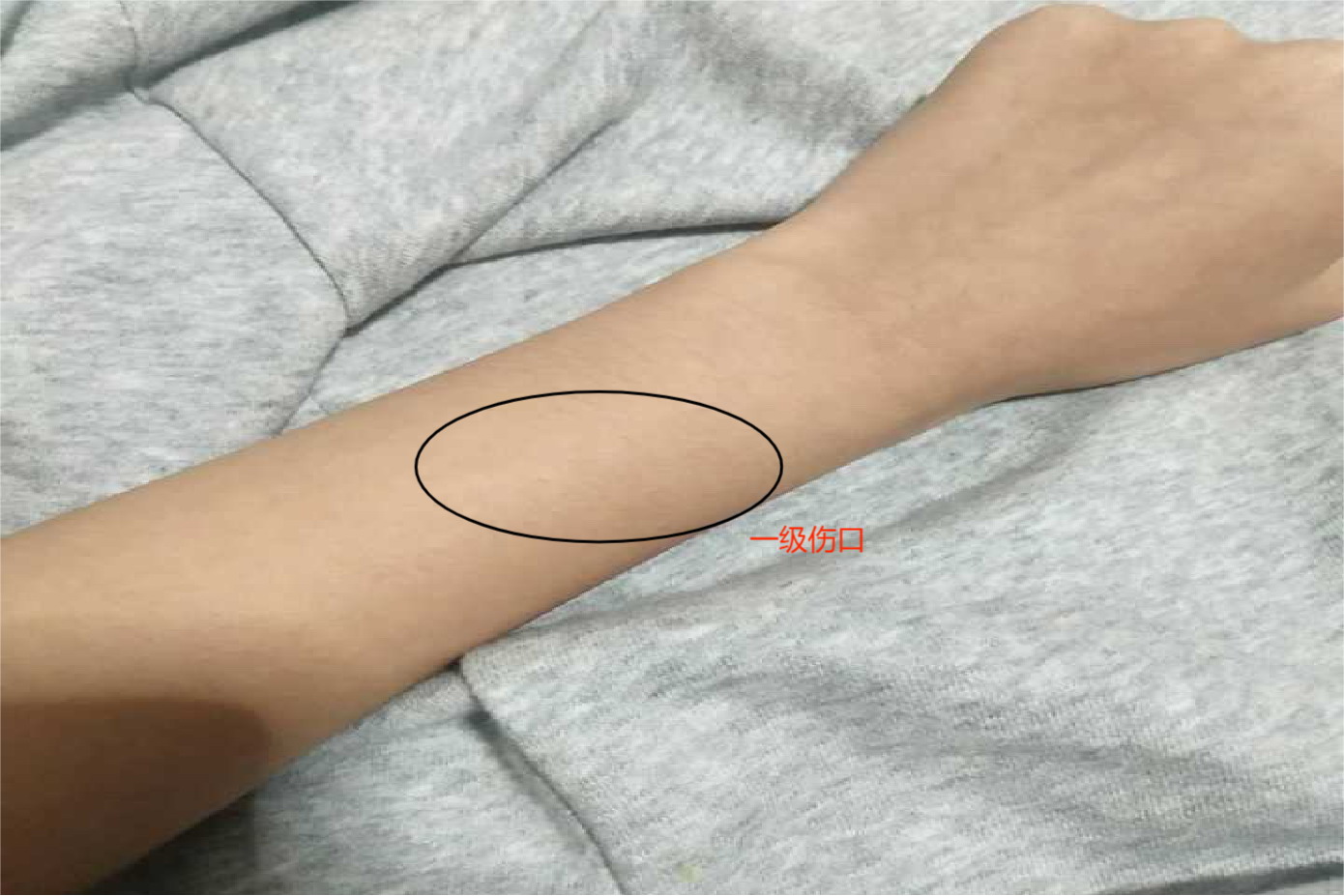 被狗咬伤一级伤口图