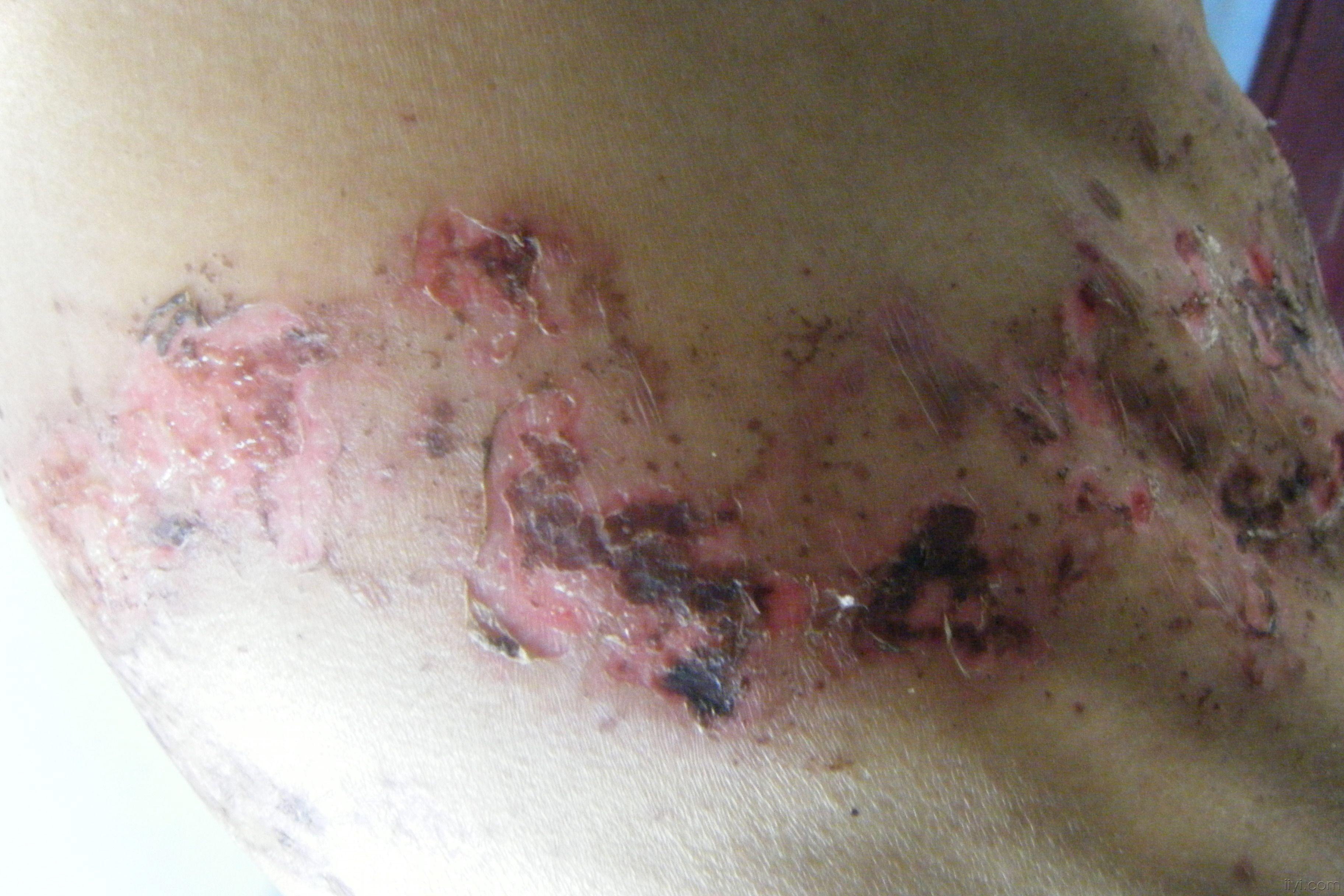 带状疱疹结痂恢复图