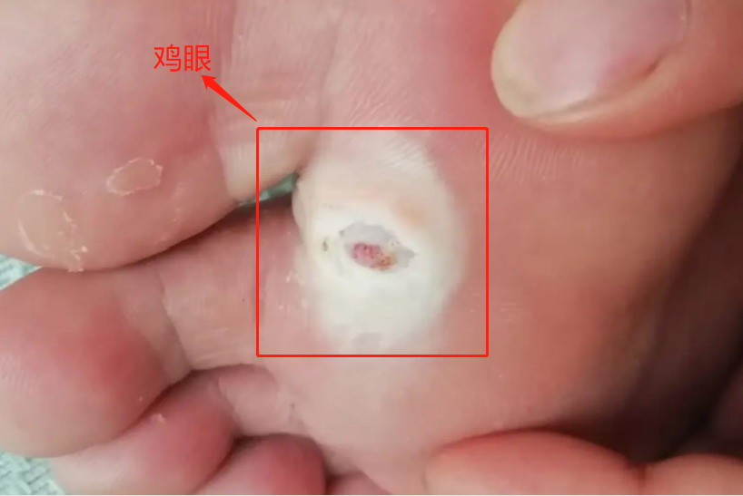 鸡眼图片
