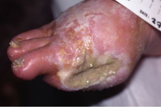 伤口感染白色腐肉