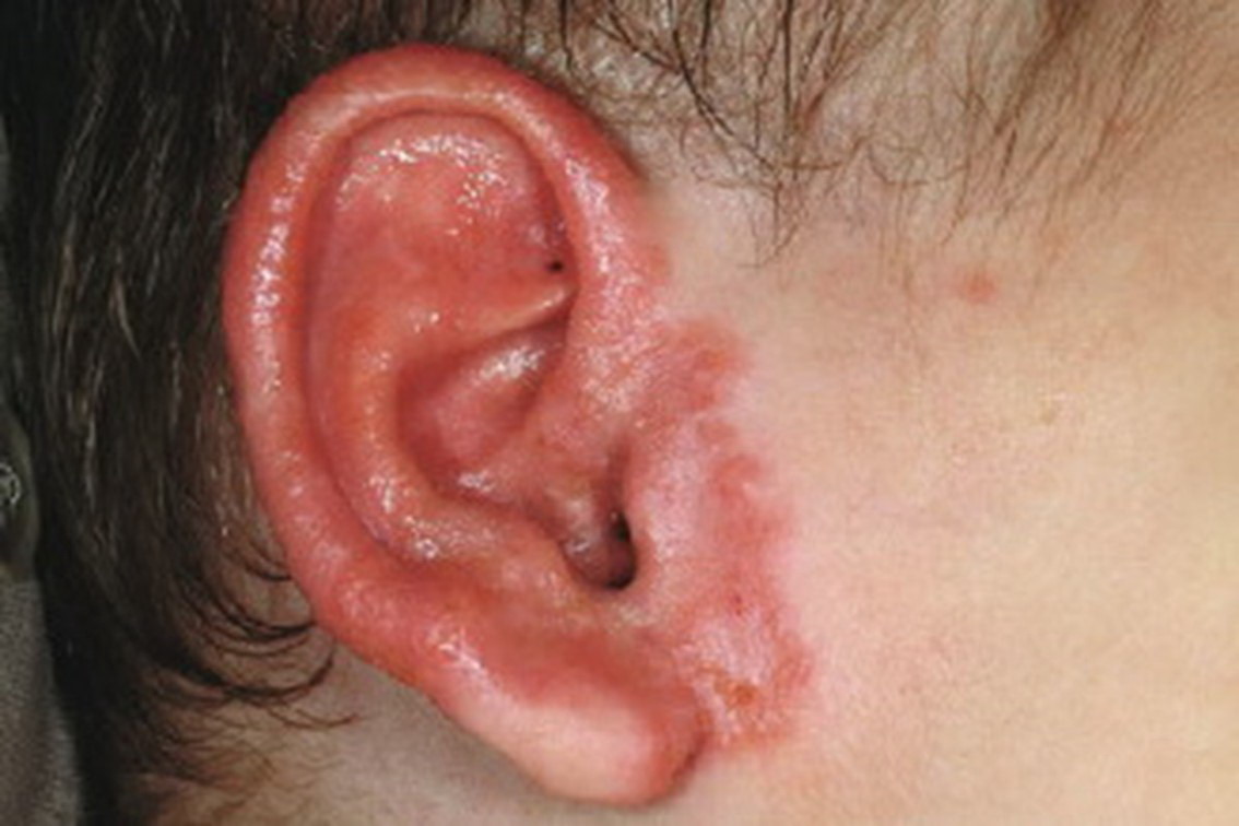 耳癣初期图