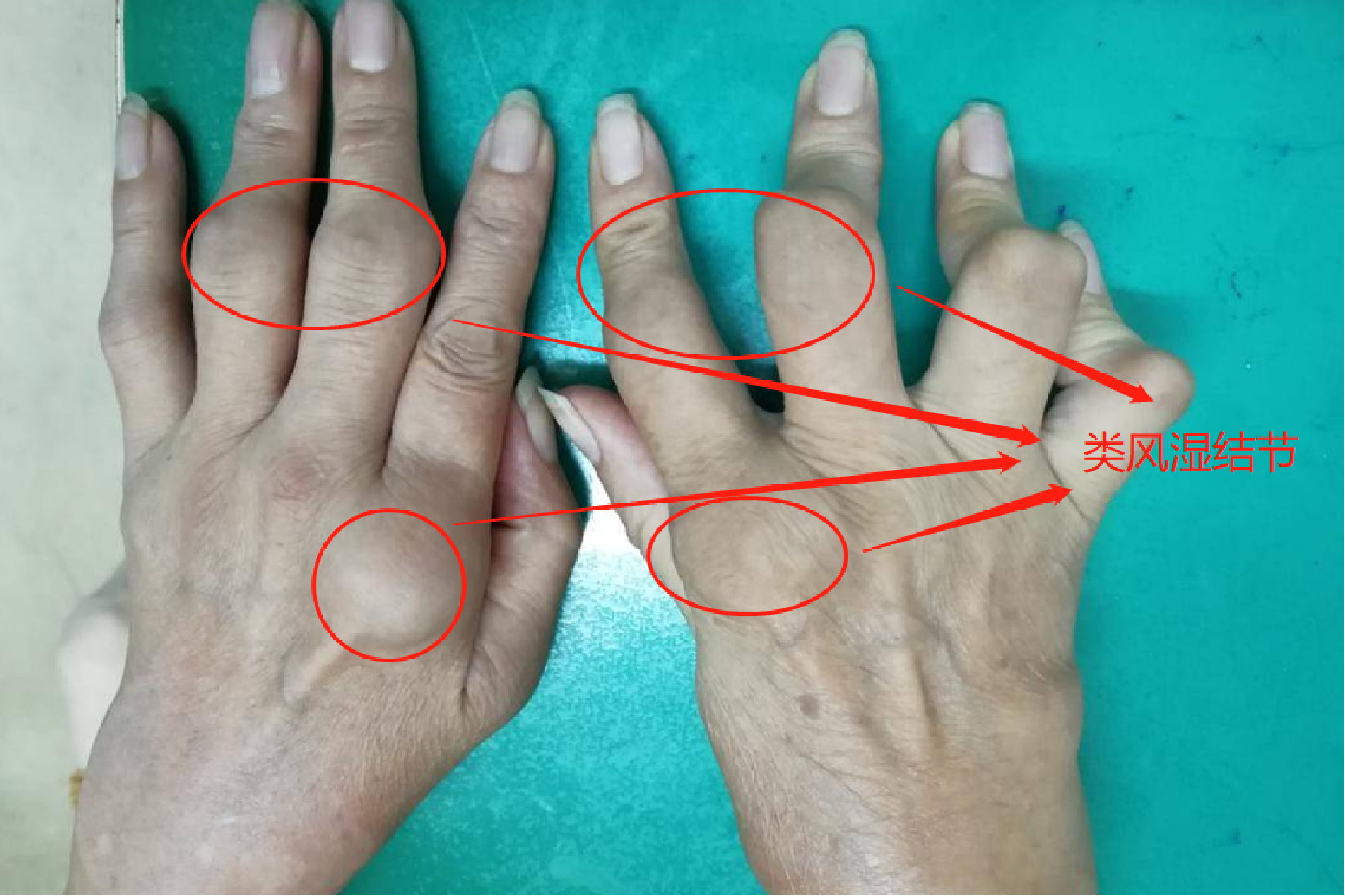 类风湿结节图