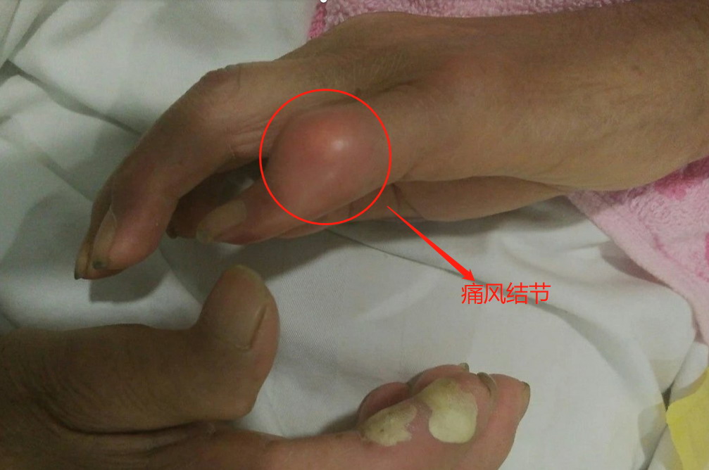 痛风结节图